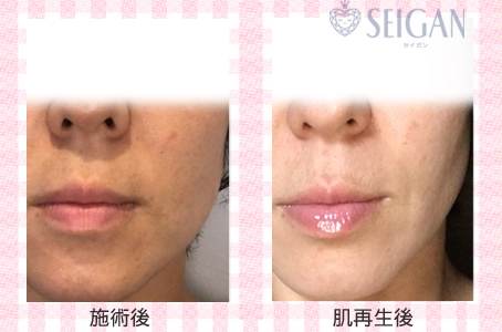 肌質改善・アンチエイジング・ニキビ・ニキビ跡（痕）FCRトリートメントビフォーアフター写真｜FCRハーブトリートメント｜50代・60代・70代から始めるエステ SEIGAN ｾｲｶﾞﾝ 【奥沢・自由が丘・田園調布】