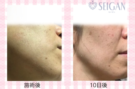 肌質改善・アンチエイジング・ニキビ・ニキビ跡（痕）FCRトリートメントビフォーアフター写真｜FCRハーブトリートメント｜50代・60代・70代から始めるエステ SEIGAN ｾｲｶﾞﾝ 【奥沢・自由が丘・田園調布】