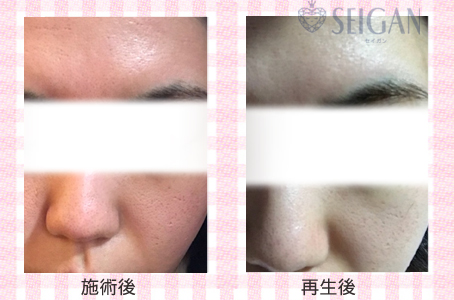 肌質改善・アンチエイジング・ニキビ・ニキビ跡（痕）FCRトリートメントビフォーアフター写真｜FCRハーブトリートメント｜50代・60代・70代から始めるエステ SEIGAN ｾｲｶﾞﾝ 【奥沢・自由が丘・田園調布】