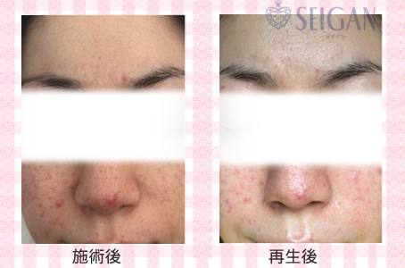 肌質改善・アンチエイジング・ニキビ・ニキビ跡（痕）FCRトリートメントビフォーアフター写真｜FCRハーブトリートメント｜50代・60代・70代から始めるエステ SEIGAN ｾｲｶﾞﾝ 【奥沢・自由が丘・田園調布】