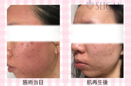 肌質改善・アンチエイジング・ニキビ・ニキビ跡（痕）FCRトリートメントビフォーアフター写真｜FCRハーブトリートメント｜50代・60代・70代から始めるエステ SEIGAN ｾｲｶﾞﾝ 【奥沢・自由が丘・田園調布】