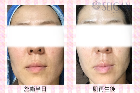 肌質改善・アンチエイジング・ニキビ・ニキビ跡（痕）FCRトリートメントビフォーアフター写真｜FCRハーブトリートメント｜50代・60代・70代から始めるエステ SEIGAN ｾｲｶﾞﾝ 【奥沢・自由が丘・田園調布】