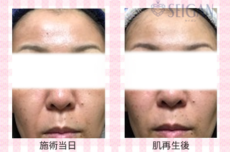 肌質改善・アンチエイジング・ニキビ・ニキビ跡（痕）FCRトリートメントビフォーアフター写真｜FCRハーブトリートメント｜50代・60代・70代から始めるエステ SEIGAN ｾｲｶﾞﾝ 【奥沢・自由が丘・田園調布】