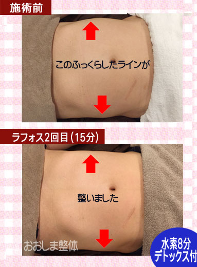 ラフォスによる痩身の効果ビフォーアフター｜東京 からだのことなら｜肌・頭皮（薄毛）の悩みの改善に「ヒト幹細胞と植物幹細胞による」メディカル系エステケア