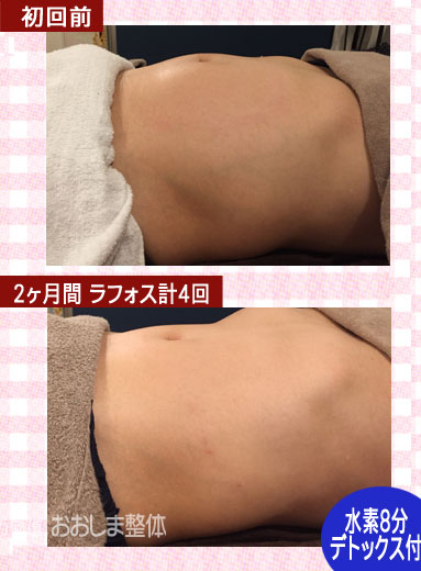ラフォスによる痩身の効果ビフォーアフター｜東京 からだのことなら｜肌・頭皮（薄毛）の悩みの改善に「ヒト幹細胞と植物幹細胞による」メディカル系エステケア
