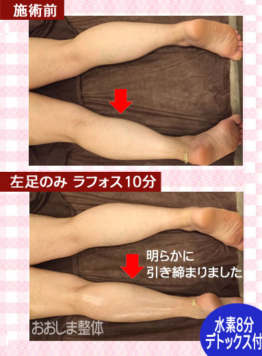 ラフォスによる痩身の効果ビフォーアフター｜東京 からだのことなら｜肌・頭皮（薄毛）の悩みの改善に「ヒト幹細胞と植物幹細胞による」メディカル系エステケア