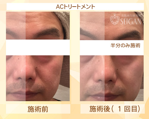 東京 からだのことなら|肌・頭皮(薄毛)の悩みの改善に「ヒト幹細胞と植物幹細胞による」メディカル系フェイシャルエステケア|FCR・リアボーテハーブ・ACトリートメント・クレアスキン基礎化粧品の正規取扱いサロンです。ニキビ・ニキビ跡(痕)・クレーター・色素沈着・シワ・シミ・たるみ・毛穴のお悩みに肌質改善を|ビフォーアフター写真