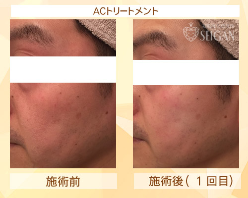 東京 からだのことなら|肌・頭皮(薄毛)の悩みの改善に「ヒト幹細胞と植物幹細胞による」メディカル系フェイシャルエステケア|FCR・リアボーテハーブ・ACトリートメント・クレアスキン基礎化粧品の正規取扱いサロンです。ニキビ・ニキビ跡(痕)・クレーター・色素沈着・シワ・シミ・たるみ・毛穴のお悩みに肌質改善を|ビフォーアフター写真