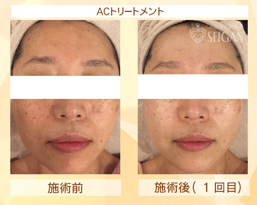 東京 からだのことなら|肌・頭皮(薄毛)の悩みの改善に「ヒト幹細胞と植物幹細胞による」メディカル系フェイシャルエステケア|FCR・リアボーテハーブ・ACトリートメント・クレアスキン基礎化粧品の正規取扱いサロンです。ニキビ・ニキビ跡(痕)・クレーター・色素沈着・シワ・シミ・たるみ・毛穴のお悩みに肌質改善を|ビフォーアフター写真