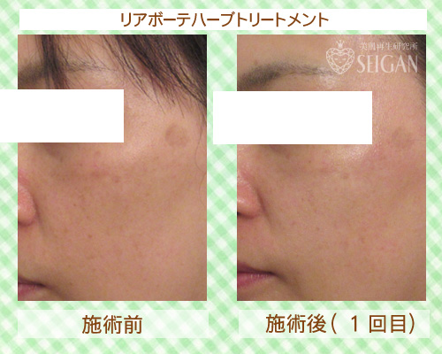 東京 からだのことなら|肌・頭皮(薄毛)の悩みの改善に「ヒト幹細胞と植物幹細胞による」メディカル系フェイシャルエステケア|FCR・リアボーテハーブ・ACトリートメント・クレアスキン基礎化粧品の正規取扱いサロンです。ニキビ・ニキビ跡(痕)・クレーター・色素沈着・シワ・シミ・たるみ・毛穴のお悩みに肌質改善を|ビフォーアフター写真