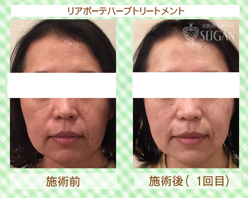 東京 からだのことなら|肌・頭皮(薄毛)の悩みの改善に「ヒト幹細胞と植物幹細胞による」メディカル系フェイシャルエステケア|FCR・リアボーテハーブ・ACトリートメント・クレアスキン基礎化粧品の正規取扱いサロンです。ニキビ・ニキビ跡(痕)・クレーター・色素沈着・シワ・シミ・たるみ・毛穴のお悩みに肌質改善を ビフォーアフター症例写真