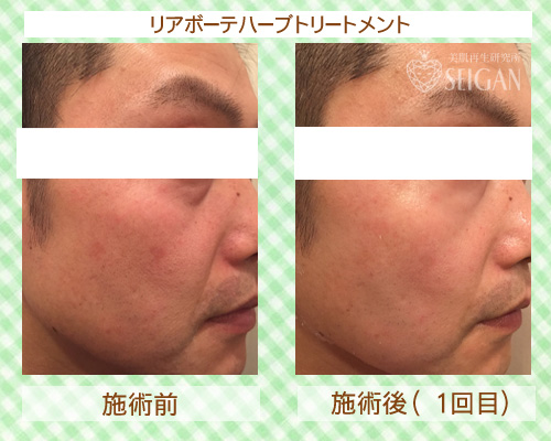 東京 からだのことなら|肌・頭皮(薄毛)の悩みの改善に「ヒト幹細胞と植物幹細胞による」メディカル系フェイシャルエステケア|FCR・リアボーテハーブ・ACトリートメント・クレアスキン基礎化粧品の正規取扱いサロンです。ニキビ・ニキビ跡(痕)・クレーター・色素沈着・シワ・シミ・たるみ・毛穴のお悩みに肌質改善を ビフォーアフター症例写真