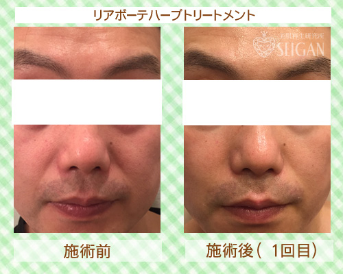 東京 からだのことなら|肌・頭皮(薄毛)の悩みの改善に「ヒト幹細胞と植物幹細胞による」メディカル系フェイシャルエステケア|FCR・リアボーテハーブ・ACトリートメント・クレアスキン基礎化粧品の正規取扱いサロンです。ニキビ・ニキビ跡(痕)・クレーター・色素沈着・シワ・シミ・たるみ・毛穴のお悩みに肌質改善を ビフォーアフター症例写真