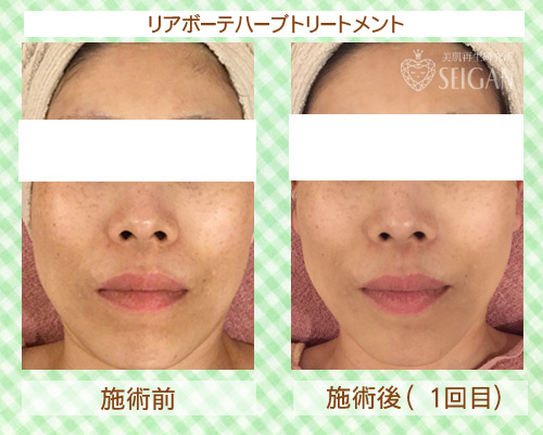 東京 からだのことなら|肌・頭皮(薄毛)の悩みの改善に「ヒト幹細胞と植物幹細胞による」メディカル系フェイシャルエステケア|FCR・リアボーテハーブ・ACトリートメント・クレアスキン基礎化粧品の正規取扱いサロンです。ニキビ・ニキビ跡(痕)・クレーター・色素沈着・シワ・シミ・たるみ・毛穴のお悩みに肌質改善を ビフォーアフター症例写真