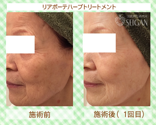 東京 からだのことなら|肌・頭皮(薄毛)の悩みの改善に「ヒト幹細胞と植物幹細胞による」メディカル系フェイシャルエステケア|FCR・リアボーテハーブ・ACトリートメント・クレアスキン基礎化粧品の正規取扱いサロンです。ニキビ・ニキビ跡(痕)・クレーター・色素沈着・シワ・シミ・たるみ・毛穴のお悩みに肌質改善を ビフォーアフター症例写真