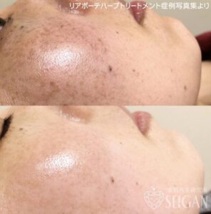 東京 からだのことなら｜肌・頭皮（薄毛）の悩みの改善に「ヒト幹細胞と植物幹細胞による」メディカル系フェイシャルエステケア｜FCR・リアボーテハーブ・ACトリートメント・クレアスキン基礎化粧品の正規取扱いサロンです。ニキビ・ニキビ跡（痕）・クレーター・色素沈着・シワ・シミ・たるみ・毛穴のお悩みに肌質改善を　ビフォーアフター症例写真