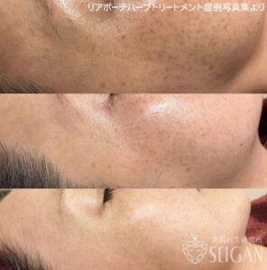 東京 からだのことなら｜肌・頭皮（薄毛）の悩みの改善に「ヒト幹細胞と植物幹細胞による」メディカル系フェイシャルエステケア｜FCR・リアボーテハーブ・ACトリートメント・クレアスキン基礎化粧品の正規取扱いサロンです。ニキビ・ニキビ跡（痕）・クレーター・色素沈着・シワ・シミ・たるみ・毛穴のお悩みに肌質改善を　ビフォーアフター症例写真