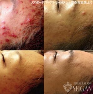 東京 からだのことなら｜肌・頭皮（薄毛）の悩みの改善に「ヒト幹細胞と植物幹細胞による」メディカル系フェイシャルエステケア｜FCR・リアボーテハーブ・ACトリートメント・クレアスキン基礎化粧品の正規取扱いサロンです。ニキビ・ニキビ跡（痕）・クレーター・色素沈着・シワ・シミ・たるみ・毛穴のお悩みに肌質改善を　ビフォーアフター症例写真