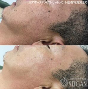 東京 からだのことなら｜肌・頭皮（薄毛）の悩みの改善に「ヒト幹細胞と植物幹細胞による」メディカル系フェイシャルエステケア｜FCR・リアボーテハーブ・ACトリートメント・クレアスキン基礎化粧品の正規取扱いサロンです。ニキビ・ニキビ跡（痕）・クレーター・色素沈着・シワ・シミ・たるみ・毛穴のお悩みに肌質改善を　ビフォーアフター症例写真