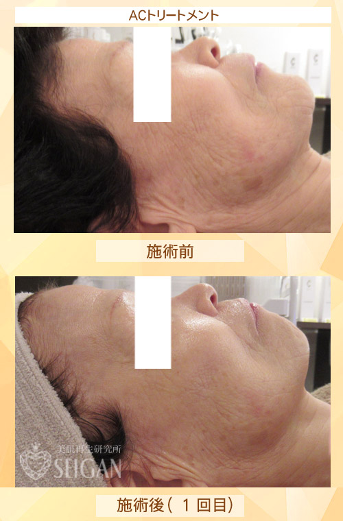 東京 からだのことなら|肌・頭皮(薄毛)の悩みの改善に「ヒト幹細胞と植物幹細胞による」メディカル系フェイシャルエステケア|FCR・リアボーテハーブ・ACトリートメント・クレアスキン基礎化粧品の正規取扱いサロンです。ニキビ・ニキビ跡(痕)・クレーター・色素沈着・シワ・シミ・たるみ・毛穴のお悩みに肌質改善を