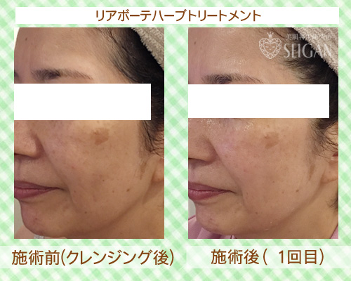 初めてリアボーテハーブピーリングを受けた効果は?ビフォーアフター写真公開|東京 からだのことなら|肌・頭皮(薄毛)の悩みの改善に「ヒト幹細胞と植物幹細胞による」メディカル系フェイシャルエステケア|FCR・リアボーテハーブ・ACトリートメント・クレアスキン基礎化粧品の正規取扱いサロンです。ニキビ・ニキビ跡・クレーター・色素沈着・シワ・シミ・たるみ・毛穴のお悩みに肌質改善を
