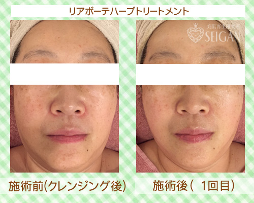 初めてリアボーテハーブピーリングを受けた効果は?ビフォーアフター写真公開|東京 からだのことなら|肌・頭皮(薄毛)の悩みの改善に「ヒト幹細胞と植物幹細胞による」メディカル系フェイシャルエステケア|FCR・リアボーテハーブ・ACトリートメント・クレアスキン基礎化粧品の正規取扱いサロンです。ニキビ・ニキビ跡・クレーター・色素沈着・シワ・シミ・たるみ・毛穴のお悩みに肌質改善を