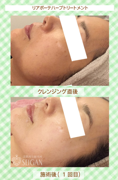 初めてリアボーテハーブピーリングを受けた効果は?ビフォーアフター写真公開|東京 からだのことなら|肌・頭皮(薄毛)の悩みの改善に「ヒト幹細胞と植物幹細胞による」メディカル系フェイシャルエステケア|FCR・リアボーテハーブ・ACトリートメント・クレアスキン基礎化粧品の正規取扱いサロンです。ニキビ・ニキビ跡・クレーター・色素沈着・シワ・シミ・たるみ・毛穴のお悩みに肌質改善を