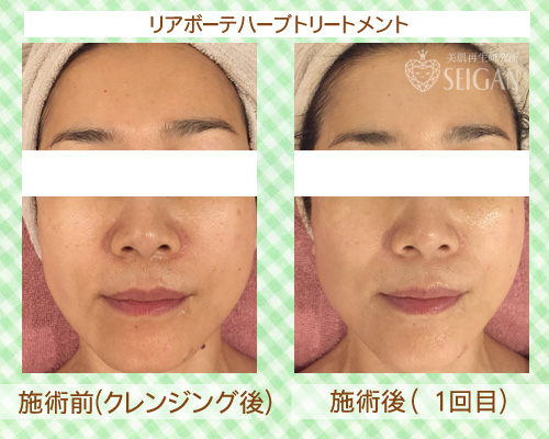 初めてリアボーテハーブピーリングを受けた効果は?ビフォーアフター写真公開|東京 からだのことなら|肌・頭皮(薄毛)の悩みの改善に「ヒト幹細胞と植物幹細胞による」メディカル系フェイシャルエステケア|FCR・リアボーテハーブ・ACトリートメント・クレアスキン基礎化粧品の正規取扱いサロンです。ニキビ・ニキビ跡・クレーター・色素沈着・シワ・シミ・たるみ・毛穴のお悩みに肌質改善を
