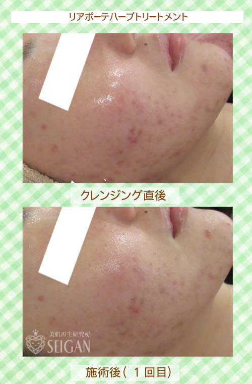 初めてリアボーテハーブピーリングを受けた効果は?ビフォーアフター写真公開|東京 からだのことなら|肌・頭皮(薄毛)の悩みの改善に「ヒト幹細胞と植物幹細胞による」メディカル系フェイシャルエステケア|FCR・リアボーテハーブ・ACトリートメント・クレアスキン基礎化粧品の正規取扱いサロンです。ニキビ・ニキビ跡・クレーター・色素沈着・シワ・シミ・たるみ・毛穴のお悩みに肌質改善を