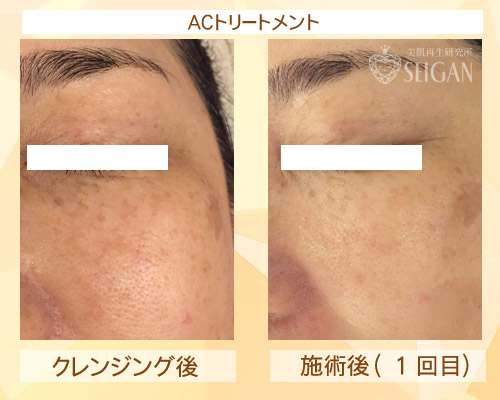 初めてリアボーテハーブピーリングを受けた効果は?ビフォーアフター写真公開|東京 からだのことなら|肌・頭皮(薄毛)の悩みの改善に「ヒト幹細胞と植物幹細胞による」メディカル系フェイシャルエステケア|FCR・リアボーテハーブ・ACトリートメント・クレアスキン基礎化粧品の正規取扱いサロンです。ニキビ・ニキビ跡・クレーター・色素沈着・シワ・シミ・たるみ・毛穴のお悩みに肌質改善を