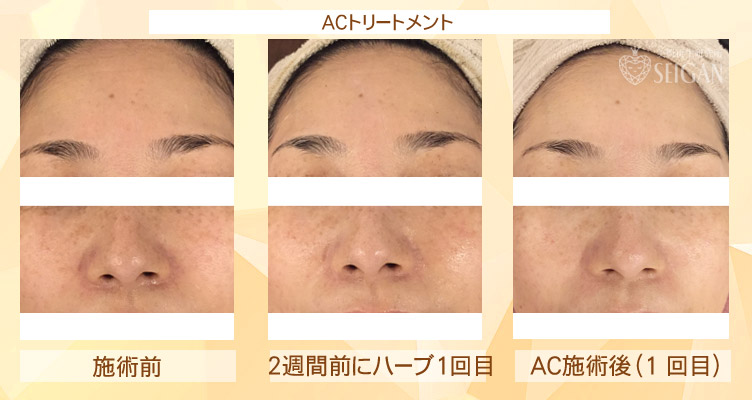 初めてリアボーテハーブピーリングを受けた効果は?ビフォーアフター写真公開|東京 からだのことなら|肌・頭皮(薄毛)の悩みの改善に「ヒト幹細胞と植物幹細胞による」メディカル系フェイシャルエステケア|FCR・リアボーテハーブ・ACトリートメント・クレアスキン基礎化粧品の正規取扱いサロンです。ニキビ・ニキビ跡・クレーター・色素沈着・シワ・シミ・たるみ・毛穴のお悩みに肌質改善を