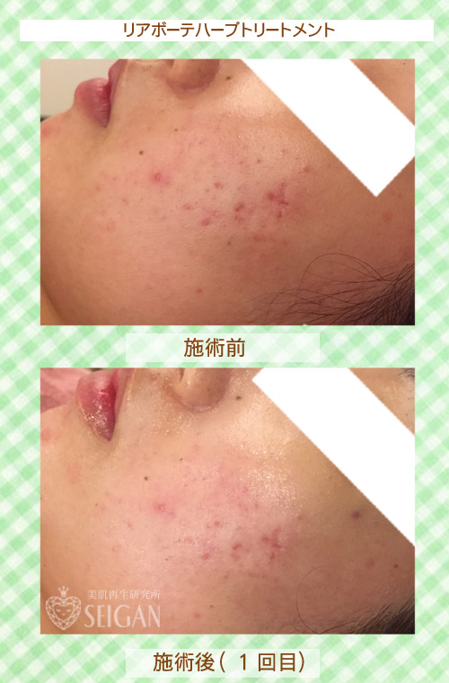 初めてリアボーテハーブピーリングを受けた効果は?ビフォーアフター写真公開|東京 からだのことなら|肌・頭皮(薄毛)の悩みの改善に「ヒト幹細胞と植物幹細胞による」メディカル系フェイシャルエステケア|FCR・リアボーテハーブ・ACトリートメント・クレアスキン基礎化粧品の正規取扱いサロンです。ニキビ・ニキビ跡・クレーター・色素沈着・シワ・シミ・たるみ・毛穴のお悩みに肌質改善を