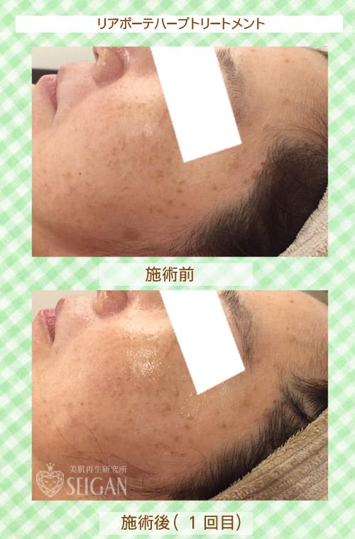 初めてリアボーテハーブピーリングを受けた効果は?ビフォーアフター写真公開|東京 からだのことなら|肌・頭皮(薄毛)の悩みの改善に「ヒト幹細胞と植物幹細胞による」メディカル系フェイシャルエステケア|FCR・リアボーテハーブ・ACトリートメント・クレアスキン基礎化粧品の正規取扱いサロンです。ニキビ・ニキビ跡・クレーター・色素沈着・シワ・シミ・たるみ・毛穴のお悩みに肌質改善を