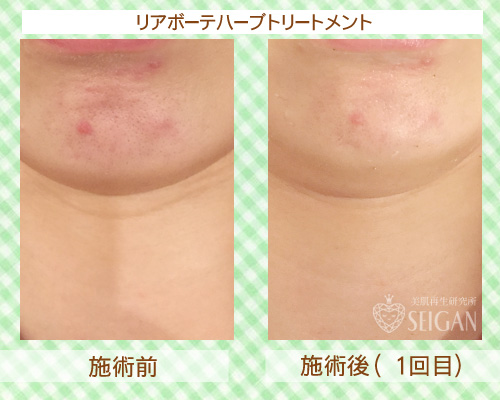 初めてリアボーテハーブピーリングを受けた効果は？ビフォーアフター写真公開｜東京 からだのことなら｜肌・頭皮（薄毛）の悩みの改善に「ヒト幹細胞と植物幹細胞による」メディカル系フェイシャルエステケア｜FCR・リアボーテハーブ・ACトリートメント・クレアスキン基礎化粧品の正規取扱いサロンです。ニキビ・ニキビ跡・クレーター・色素沈着・シワ・シミ・たるみ・毛穴のお悩みに肌質改善を