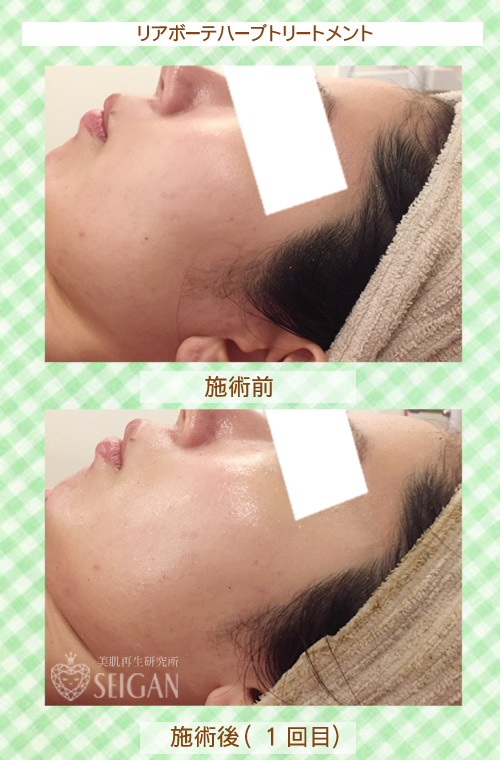 初めてリアボーテハーブピーリングを受けた効果は?ビフォーアフター写真公開|東京 からだのことなら|肌・頭皮(薄毛)の悩みの改善に「ヒト幹細胞と植物幹細胞による」メディカル系フェイシャルエステケア|FCR・リアボーテハーブ・ACトリートメント・クレアスキン基礎化粧品の正規取扱いサロンです。ニキビ・ニキビ跡・クレーター・色素沈着・シワ・シミ・たるみ・毛穴のお悩みに肌質改善を