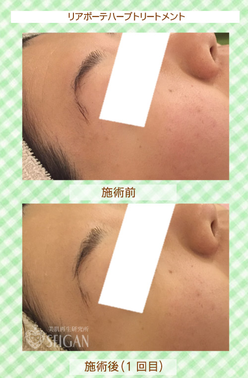 初めてリアボーテハーブピーリングを受けた効果は？ビフォーアフター写真公開｜東京 からだのことなら｜肌・頭皮（薄毛）の悩みの改善に「ヒト幹細胞と植物幹細胞による」メディカル系フェイシャルエステケア｜FCR・リアボーテハーブ・ACトリートメント・クレアスキン基礎化粧品の正規取扱いサロンです。ニキビ・ニキビ跡・クレーター・色素沈着・シワ・シミ・たるみ・毛穴のお悩みに肌質改善を