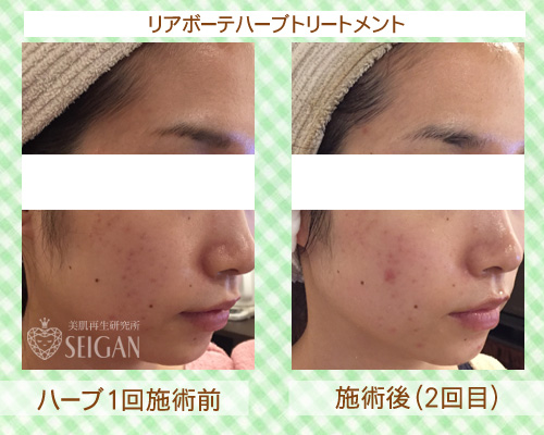 初めてリアボーテハーブピーリングを受けた効果は？ビフォーアフター写真公開｜東京 からだのことなら｜肌・頭皮（薄毛）の悩みの改善に「ヒト幹細胞と植物幹細胞による」メディカル系フェイシャルエステケア｜FCR・リアボーテハーブ・ACトリートメント・クレアスキン基礎化粧品の正規取扱いサロンです。ニキビ・ニキビ跡・クレーター・色素沈着・シワ・シミ・たるみ・毛穴のお悩みに肌質改善を
