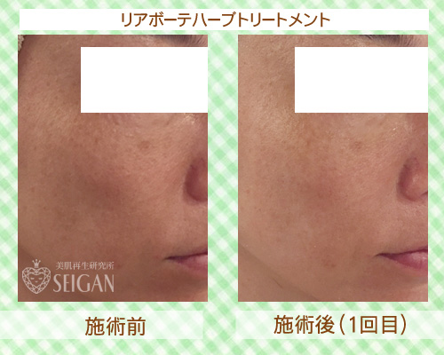 初めてリアボーテハーブピーリングを受けた効果は?ビフォーアフター写真公開|東京 からだのことなら|肌・頭皮(薄毛)の悩みの改善に「ヒト幹細胞と植物幹細胞による」メディカル系フェイシャルエステケア|FCR・リアボーテハーブ・ACトリートメント・クレアスキン基礎化粧品の正規取扱いサロンです。ニキビ・ニキビ跡・クレーター・色素沈着・シワ・シミ・たるみ・毛穴のお悩みに肌質改善を