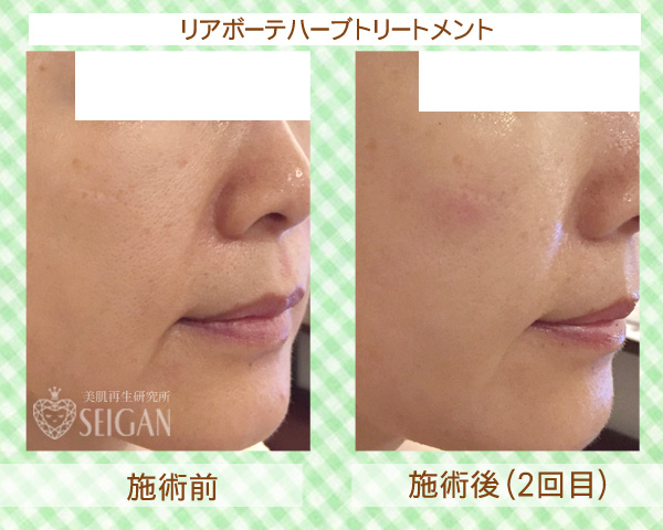 初めてリアボーテハーブピーリングを受けた効果は?ビフォーアフター写真公開|東京 からだのことなら|肌・頭皮(薄毛)の悩みの改善に「ヒト幹細胞と植物幹細胞による」メディカル系フェイシャルエステケア|FCR・リアボーテハーブ・ACトリートメント・クレアスキン基礎化粧品の正規取扱いサロンです。ニキビ・ニキビ跡・クレーター・色素沈着・シワ・シミ・たるみ・毛穴のお悩みに肌質改善を