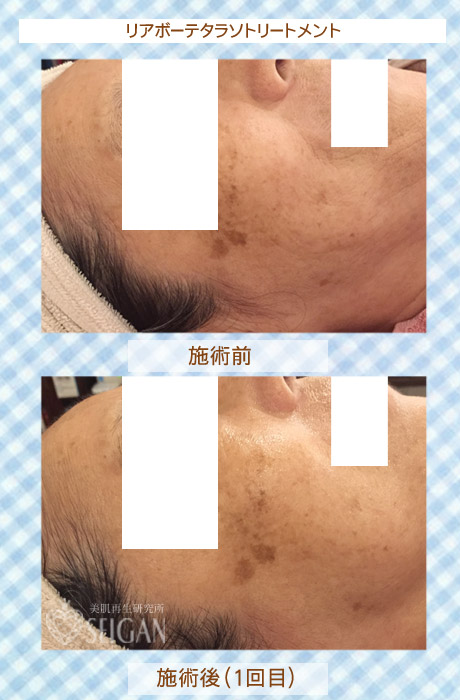 初めてリアボーテハーブピーリングを受けた効果は?ビフォーアフター写真公開|東京 からだのことなら|肌・頭皮(薄毛)の悩みの改善に「ヒト幹細胞と植物幹細胞による」メディカル系フェイシャルエステケア|FCR・リアボーテハーブ・ACトリートメント・クレアスキン基礎化粧品の正規取扱いサロンです。ニキビ・ニキビ跡・クレーター・色素沈着・シワ・シミ・たるみ・毛穴のお悩みに肌質改善を