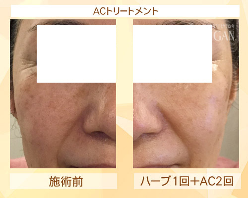 初めてACトリートメントを受けた効果は?ビフォーアフター写真公開|東京 からだのことなら|肌・頭皮(薄毛)の悩みの改善に「ヒト幹細胞と植物幹細胞による」メディカル系フェイシャルエステケア|FCR・リアボーテハーブ・ACトリートメント・クレアスキン基礎化粧品の正規取扱いサロンです。ニキビ・ニキビ跡・クレーター・色素沈着・シワ・シミ・たるみ・毛穴のお悩みに肌質改善を