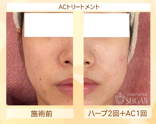 初めてACトリートメントを受けた効果は?ビフォーアフター写真公開|東京 からだのことなら|肌・頭皮(薄毛)の悩みの改善に「ヒト幹細胞と植物幹細胞による」メディカル系フェイシャルエステケア|FCR・リアボーテハーブ・ACトリートメント・クレアスキン基礎化粧品の正規取扱いサロンです。ニキビ・ニキビ跡・クレーター・色素沈着・シワ・シミ・たるみ・毛穴のお悩みに肌質改善を