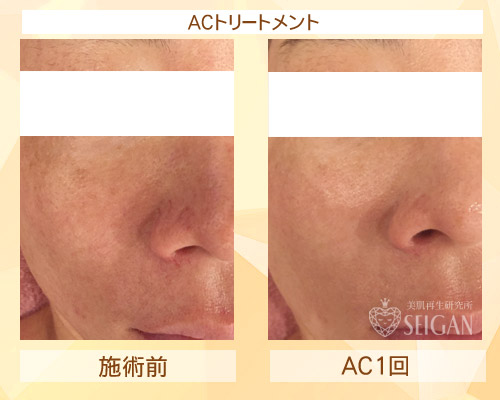 初めてACトリートメントを受けた効果は?ビフォーアフター写真公開|東京 からだのことなら|肌・頭皮(薄毛)の悩みの改善に「ヒト幹細胞と植物幹細胞による」メディカル系フェイシャルエステケア|FCR・リアボーテハーブ・ACトリートメント・クレアスキン基礎化粧品の正規取扱いサロンです。ニキビ・ニキビ跡・クレーター・色素沈着・シワ・シミ・たるみ・毛穴のお悩みに肌質改善を