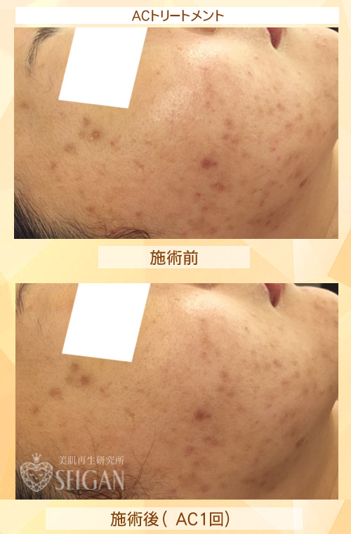 初めてACトリートメントを受けた効果は?ビフォーアフター写真公開|東京 からだのことなら|肌・頭皮(薄毛)の悩みの改善に「ヒト幹細胞と植物幹細胞による」メディカル系フェイシャルエステケア|FCR・リアボーテハーブ・ACトリートメント・クレアスキン基礎化粧品の正規取扱いサロンです。ニキビ・ニキビ跡・クレーター・色素沈着・シワ・シミ・たるみ・毛穴のお悩みに肌質改善を
