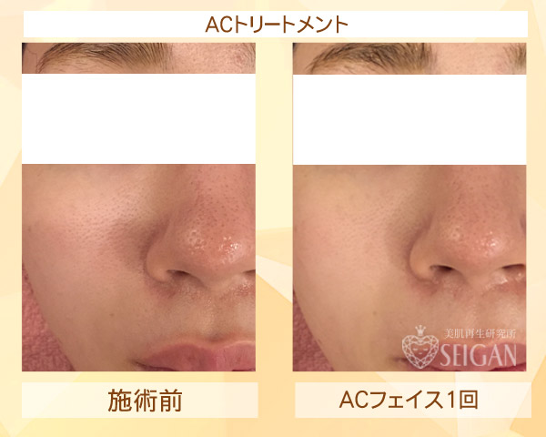 初めてACトリートメントを受けた効果は?ビフォーアフター写真公開|東京 からだのことなら|肌・頭皮(薄毛)の悩みの改善に「ヒト幹細胞と植物幹細胞による」メディカル系フェイシャルエステケア|FCR・リアボーテハーブ・ACトリートメント・クレアスキン基礎化粧品の正規取扱いサロンです。ニキビ・ニキビ跡・クレーター・色素沈着・シワ・シミ・たるみ・毛穴のお悩みに肌質改善を
