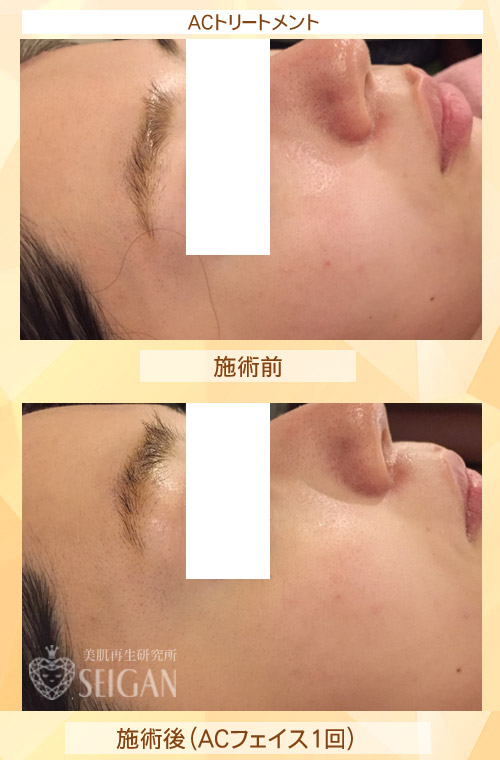 初めてACトリートメントを受けた効果は?ビフォーアフター写真公開|東京 からだのことなら|肌・頭皮(薄毛)の悩みの改善に「ヒト幹細胞と植物幹細胞による」メディカル系フェイシャルエステケア|FCR・リアボーテハーブ・ACトリートメント・クレアスキン基礎化粧品の正規取扱いサロンです。ニキビ・ニキビ跡・クレーター・色素沈着・シワ・シミ・たるみ・毛穴のお悩みに肌質改善を