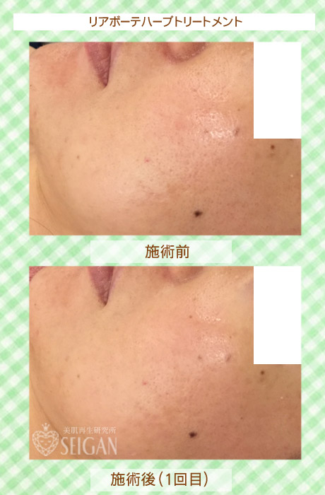 初めてリアボーテハーブピーリングを受けた効果は?ビフォーアフター写真公開|東京 からだのことなら|肌・頭皮(薄毛)の悩みの改善に「ヒト幹細胞と植物幹細胞による」メディカル系フェイシャルエステケア|FCR・リアボーテハーブ・ACトリートメント・クレアスキン基礎化粧品の正規取扱いサロンです。ニキビ・ニキビ跡・クレーター・色素沈着・シワ・シミ・たるみ・毛穴のお悩みに肌質改善を