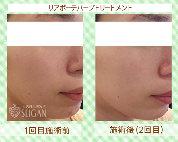 初めてリアボーテハーブピーリングを受けた効果は?ビフォーアフター写真公開|東京 からだのことなら|肌・頭皮(薄毛)の悩みの改善に「ヒト幹細胞と植物幹細胞による」メディカル系フェイシャルエステケア|FCR・リアボーテハーブ・ACトリートメント・クレアスキン基礎化粧品の正規取扱いサロンです。ニキビ・ニキビ跡・クレーター・色素沈着・シワ・シミ・たるみ・毛穴のお悩みに肌質改善を