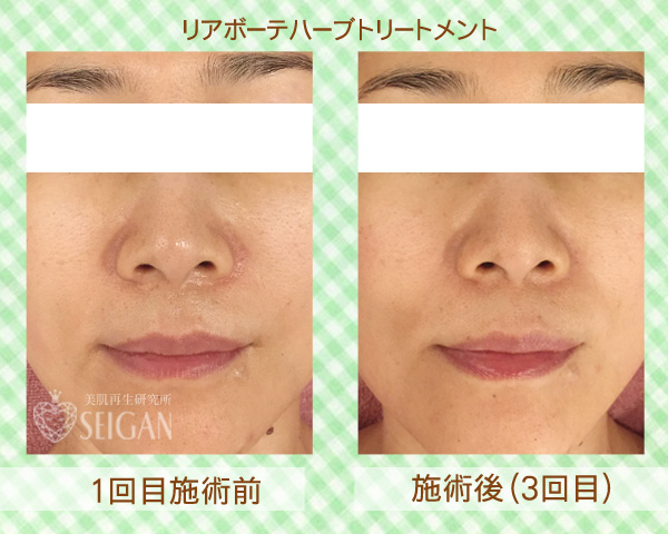 初めてリアボーテハーブピーリングを受けた効果は?ビフォーアフター写真公開|東京 からだのことなら|肌・頭皮(薄毛)の悩みの改善に「ヒト幹細胞と植物幹細胞による」メディカル系フェイシャルエステケア|FCR・リアボーテハーブ・ACトリートメント・クレアスキン基礎化粧品の正規取扱いサロンです。ニキビ・ニキビ跡・クレーター・色素沈着・シワ・シミ・たるみ・毛穴のお悩みに肌質改善を