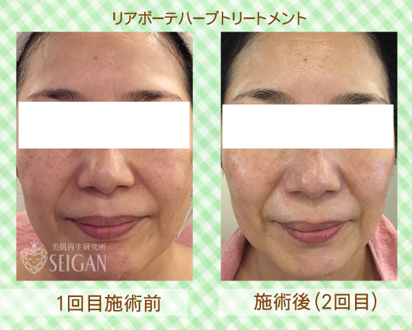 初めてリアボーテハーブピーリングを受けた効果は?ビフォーアフター写真公開|東京 からだのことなら|肌・頭皮(薄毛)の悩みの改善に「ヒト幹細胞と植物幹細胞による」メディカル系フェイシャルエステケア|FCR・リアボーテハーブ・ACトリートメント・クレアスキン基礎化粧品の正規取扱いサロンです。ニキビ・ニキビ跡・クレーター・色素沈着・シワ・シミ・たるみ・毛穴のお悩みに肌質改善を